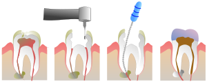 endodoncia