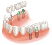 implantes 4