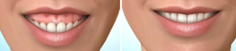 sonrisa gingival